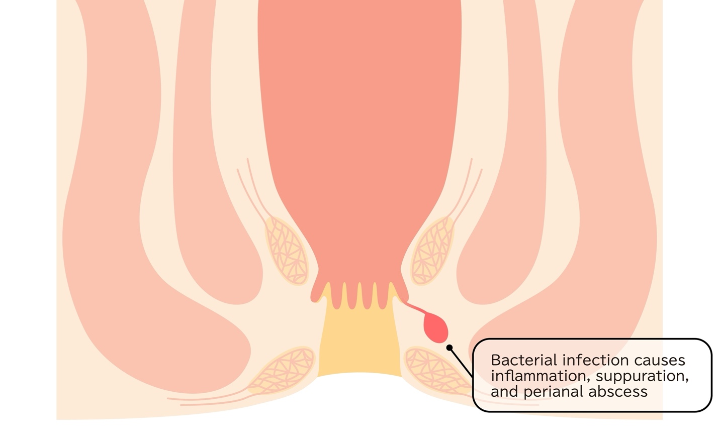 Perianal Abscess Treatment Singapore | Surgery & Drainage | Dr Ganesh